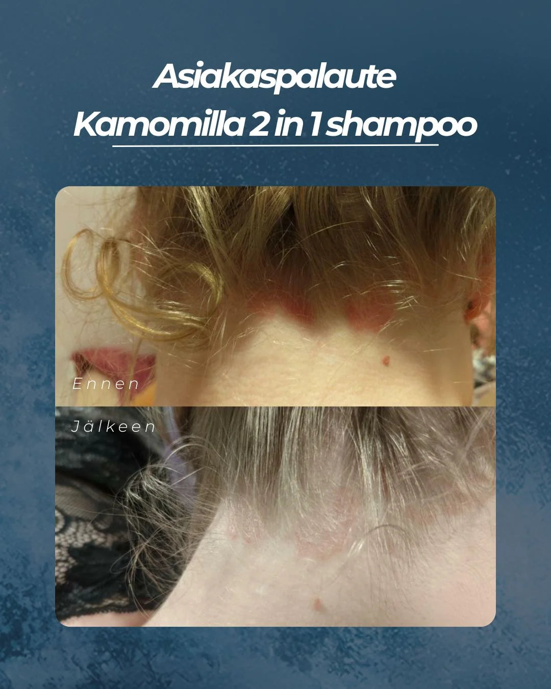 SAARENTAIKA VIHREÄ TEE & KAMOMILLA 2 IN 1 SHAMPOO 105 g – psoriasis-päänahalle ja vartalolle