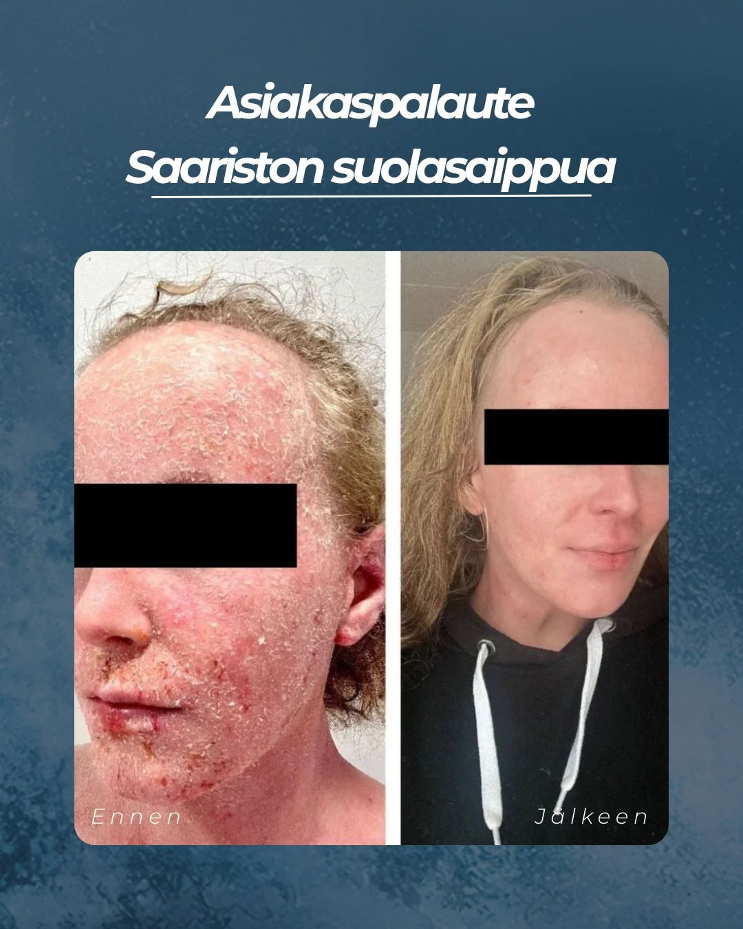 SAARISTON SUOLASAIPPUA® 100 g – Hajusteeton suolasaippua kuivalle, herkälle ja atooppiselle iholle