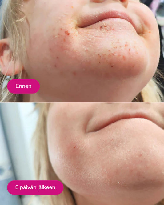 PROPOLIS & PROBIOTICS RESCUE CREAM 30 ml - rauhoittava tästävoide ongelmaiholle