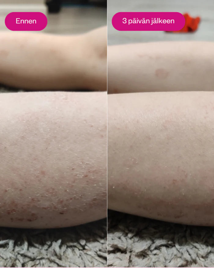 PROPOLIS & PROBIOTICS RESCUE CREAM 30 ml - rauhoittava tästävoide ongelmaiholle